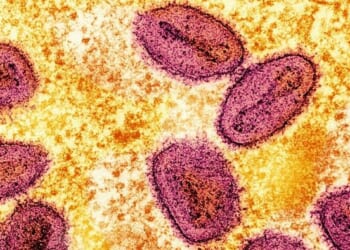 Severe Mpox Virus Strain Possibly Spreading In LA County, Officials Warn