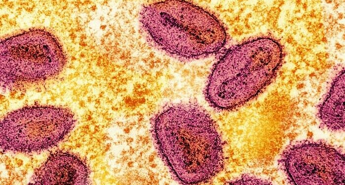 Severe Mpox Virus Strain Possibly Spreading In LA County, Officials Warn