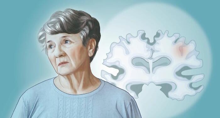 Alzheimer's Disease: The Most Common Neurodegenerative Disease - Here Are The Causes