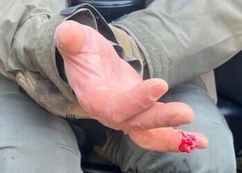 Lefty Protestor Bites Off Federal Officer's Finger