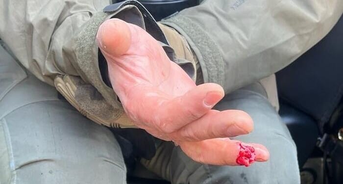 Lefty Protestor Bites Off Federal Officer's Finger