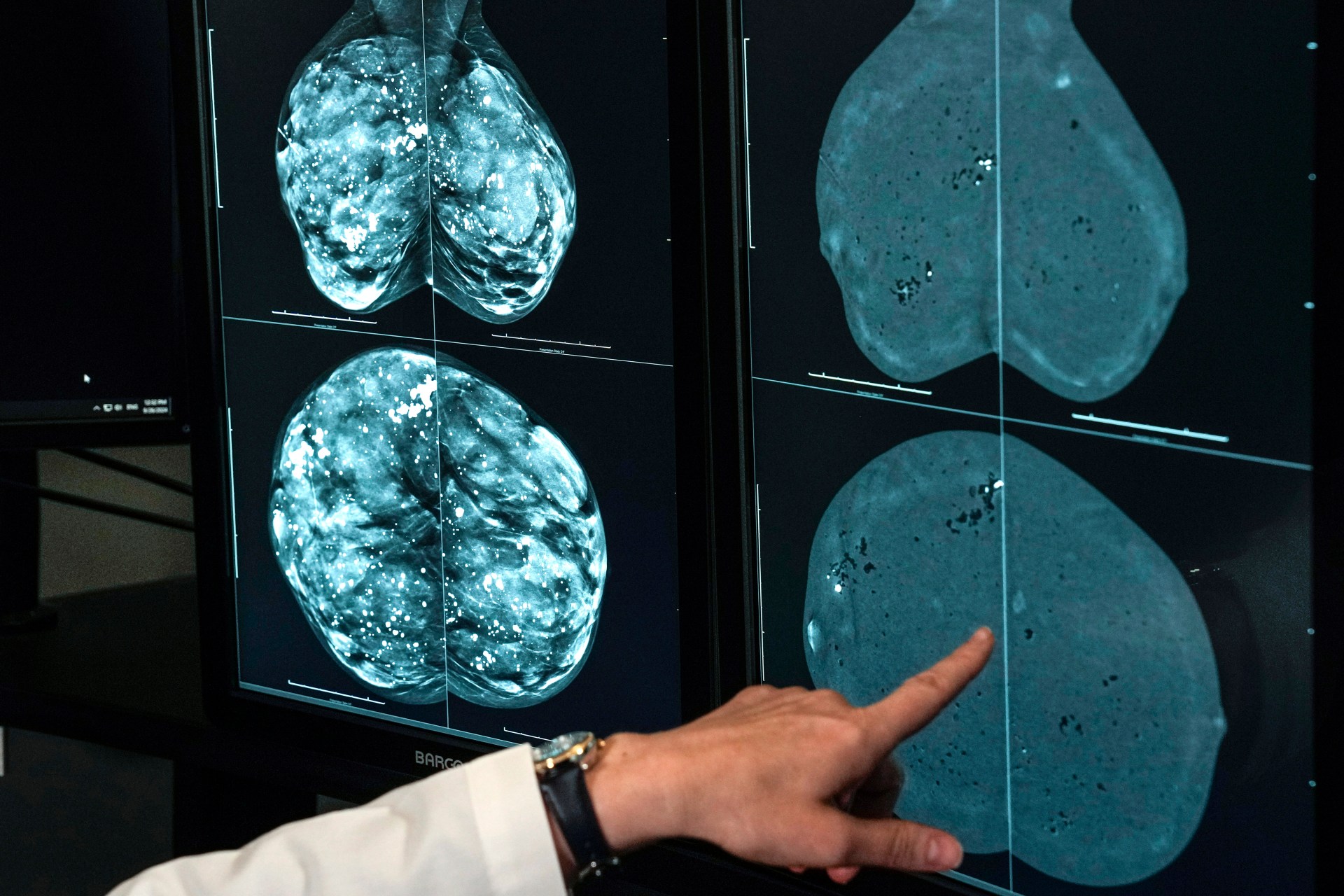 A healthcare professional points to mammogram images displayed on medical monitors, examining breast imaging scans for diagnostic purposes.